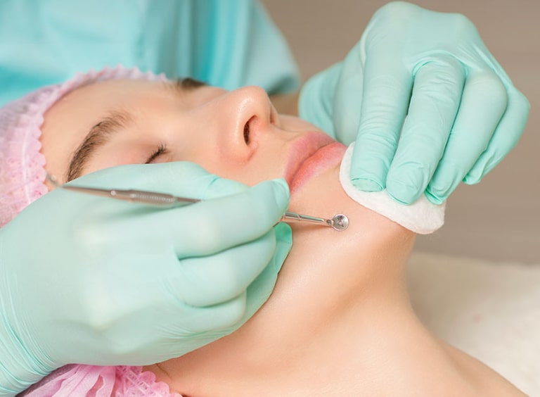 có nên đi spa trị mụn đầu đen không