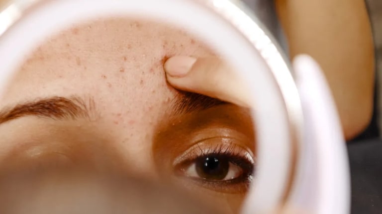 có nên đi spa trị mụn đầu đen