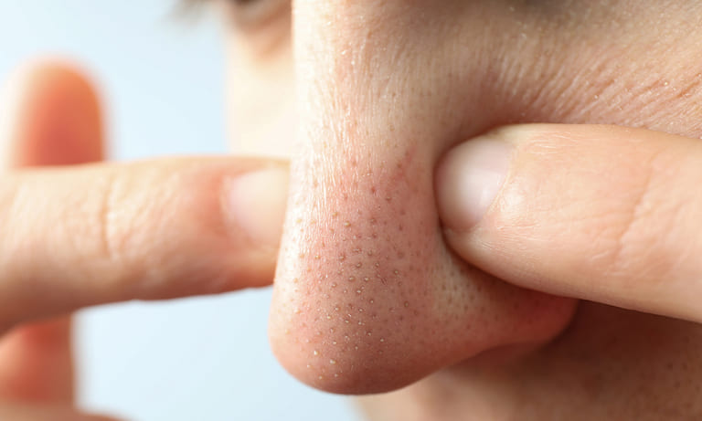không nặn mụn có tự hết được không