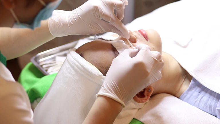 nên nặn mụn bao lâu 1 lần