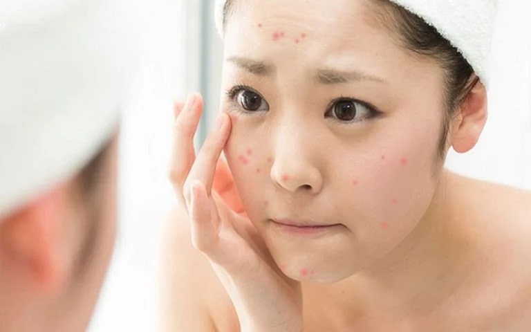 Những điều cần lưu ý sau khi nặn mụn