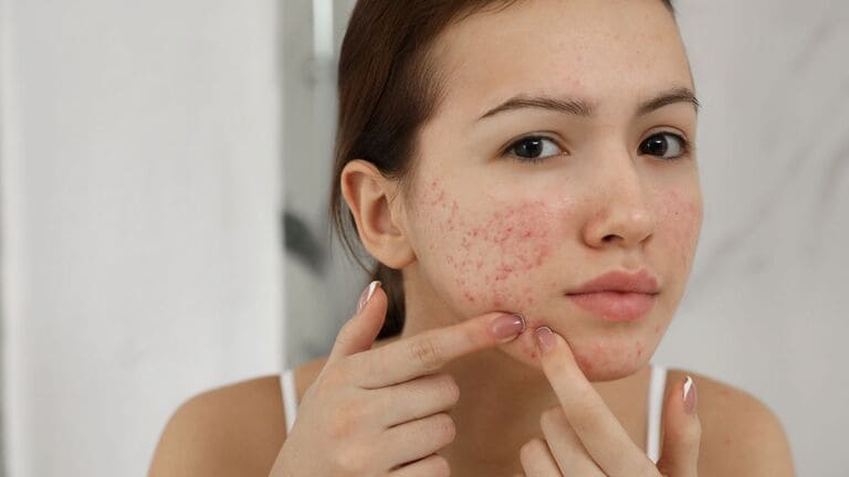 mới nặn mụn xong nên làm gì cho da khỏe