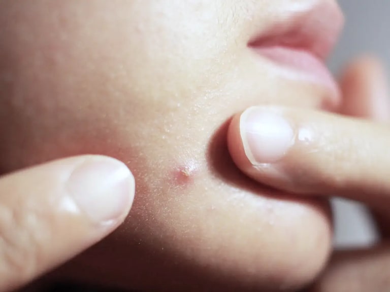 Spa lấy nhân mụn gần đây