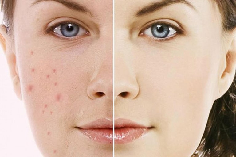 spa trị mụn thủ đức