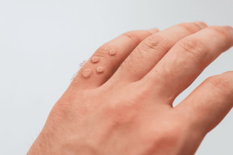 Spa trị mụn thịt uy tín