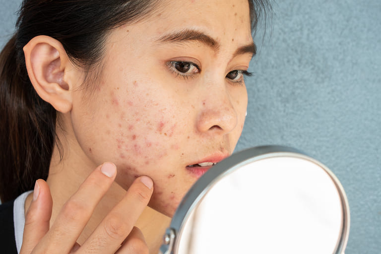 Cách Trị Mụn Bằng Hồ Nước Siêu Hiệu Quả, An Toàn Nhất