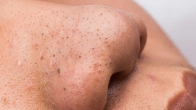 Cách trị mụn bằng phấn rôm hiệu quả