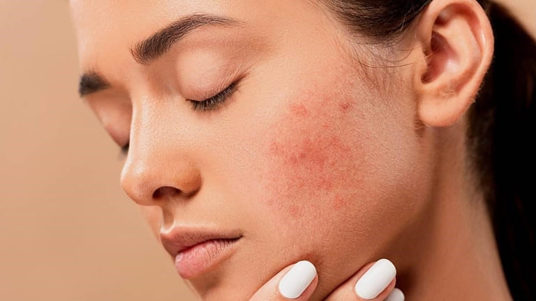 trị mụn bằng thuốc bắc