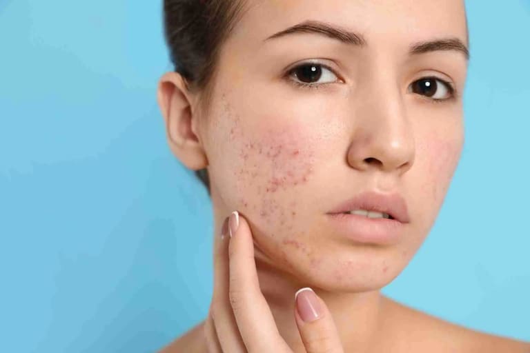 Cách Trị Mụn Thâm Bằng Mỡ Trăn Hiệu Quả, An Toàn Tại Nhà
