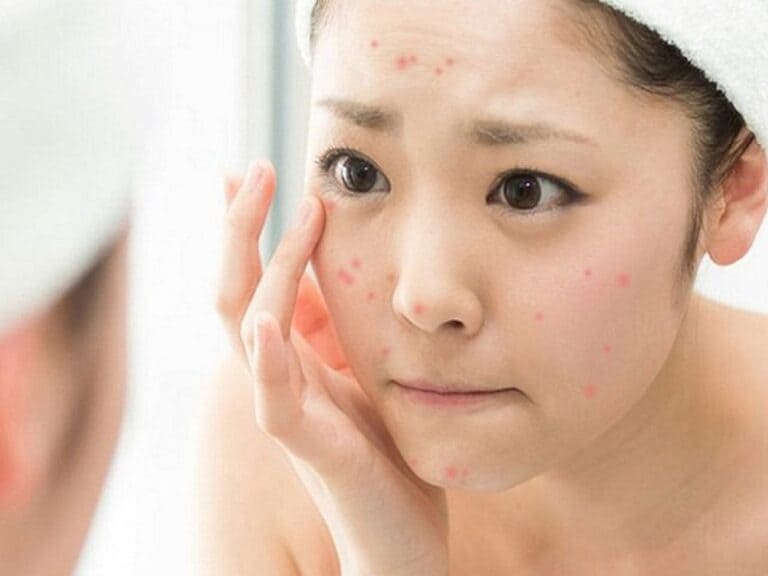 nặn mụn khi đang dùng bha có sao không