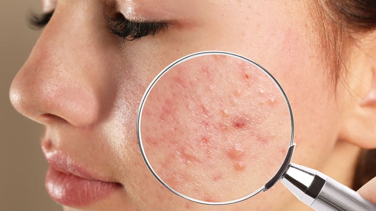 có nên nặn mụn trong ngày đèn đỏ hay không