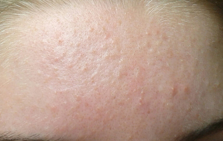 Vcó nên peel da sau khi nặn mụn không