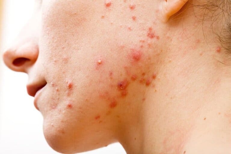có nên peel da sau khi nặn mụn hay không