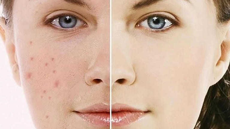 giá trị thâm mụn ở spa mới nhất