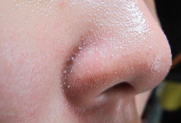 các loại mụn