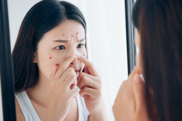nặn mụn có sao không