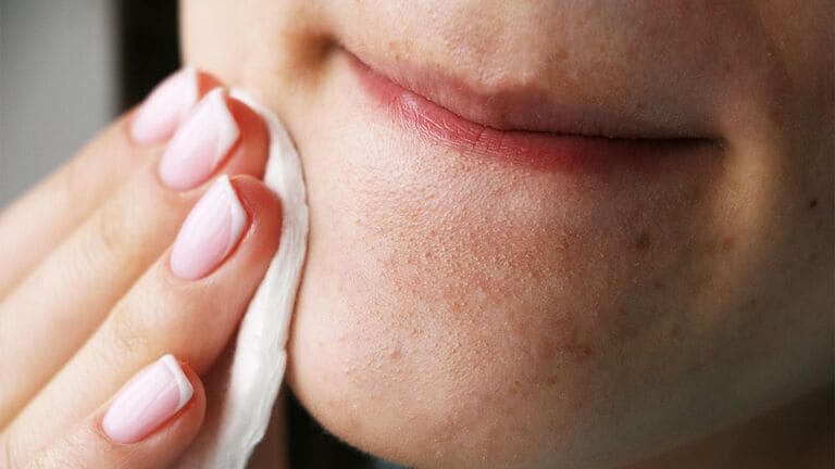nên nặn mụn vào thời gian nào trong ngày tốt nhất